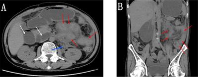 A Patient With Erdheim-Chester Disease Presenting With Intestinal Obstruction as the Initial Symptom: A Case Report